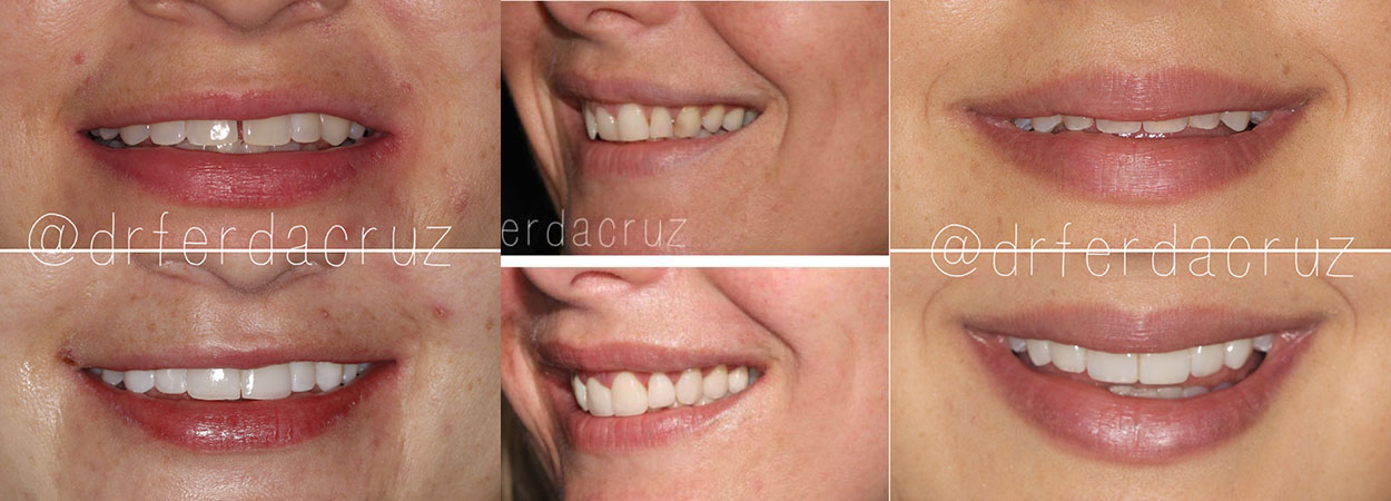 Smile Makeover, Before and After Pics, San Jose, Costa Rica